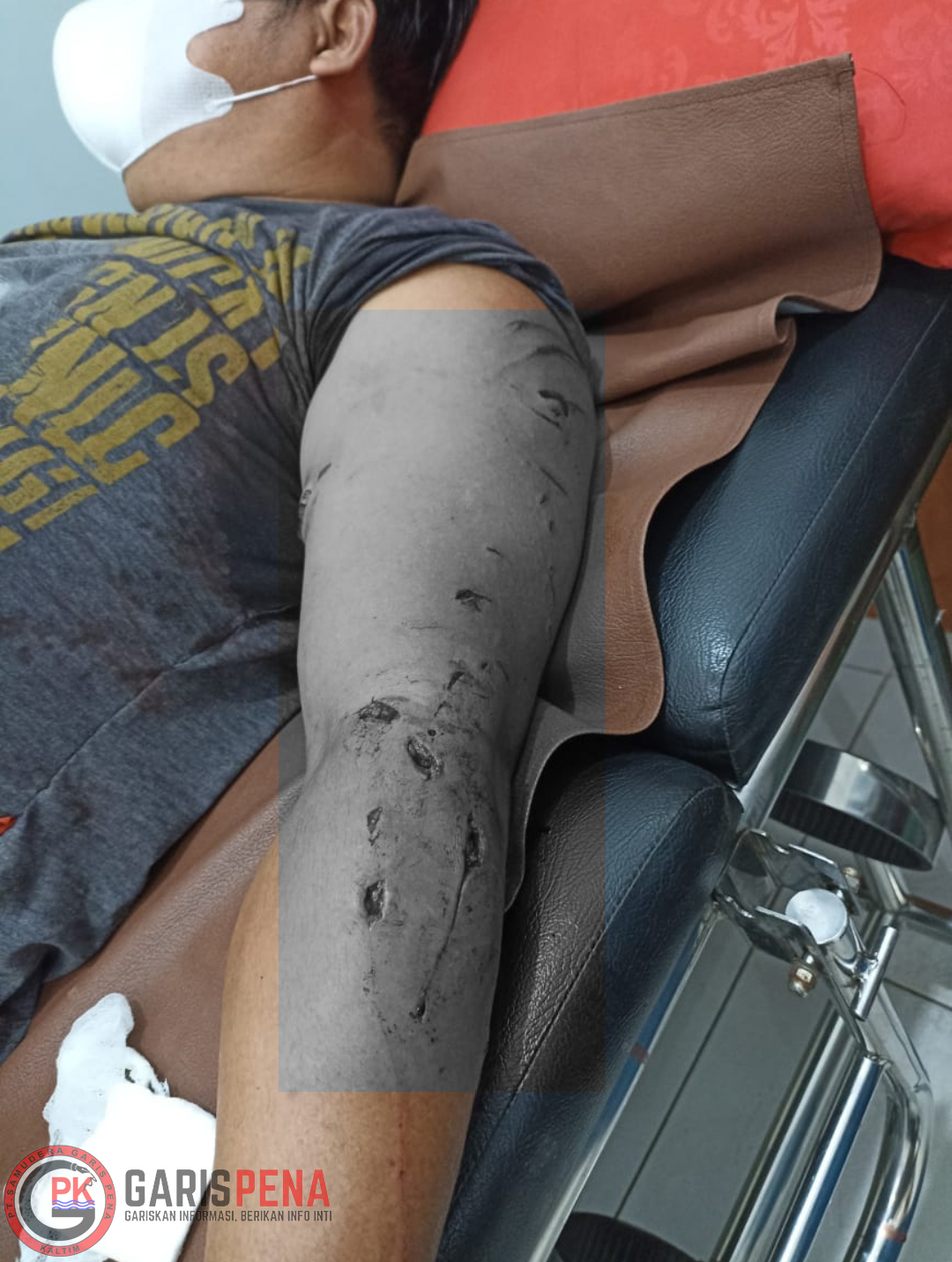 Foto: Kondisi tangan Iwan usai diserang buaya berukuran 2 meter